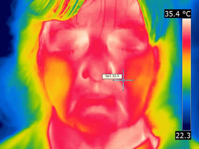 Conventional thermal image patient C