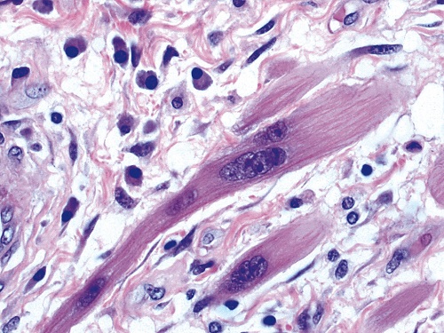 Development of cancer cells in disorganized stroma