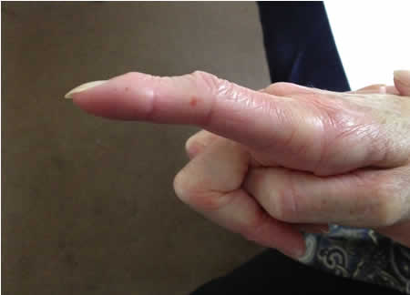Arthritis of hand