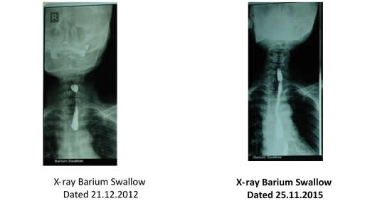 X-ray Barium Swallows