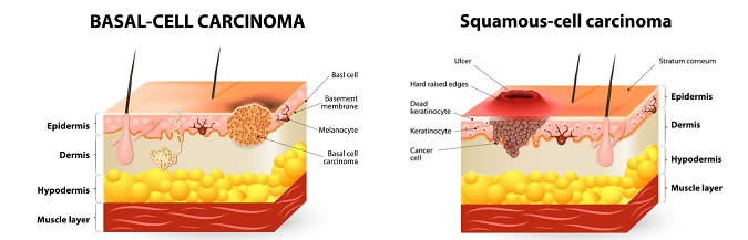 Basal-Cell and Saumous-Cell Carcinoma
