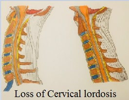 LossofcervicalLordosis