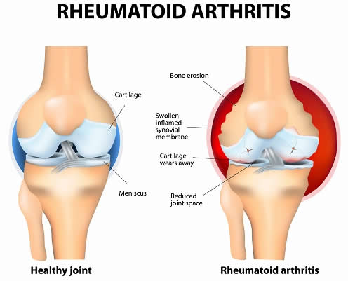 rheumatoid-arthritis-diagram