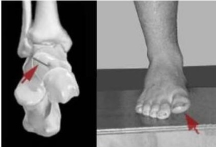 Rothbarts Foot showing incomplete talus and inverted big toe