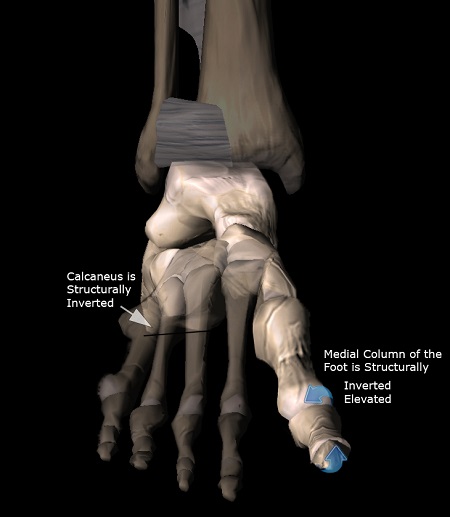 PreClinical Clubfoot Structure