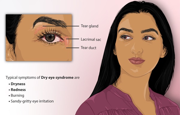 Depiction_of_a_person_suffering_from_Dry_Eye_Syndrome