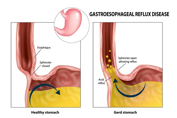 Figure 2 Stomach and Lower Esophageal Sphincter