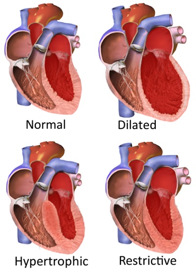 Types of Cardiomyopathy